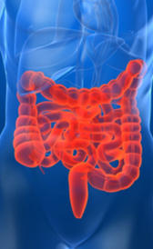 cáncer de colon Imagen de la cáncer de colon