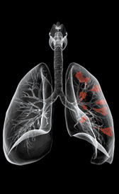 cáncer de pulmón Imagen de la cáncer de pulmón