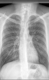 enfermedad pulmonar obstructiva cronica Imagen de la enfermedad pulmonar obstructiva cronica