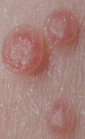 herpes genital Imagen de la herpes genital