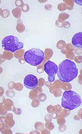 leucemia Imagen de la leucemia