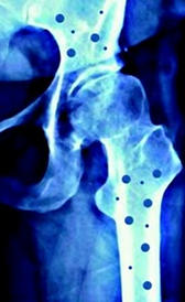 osteoporosis Imagen de la osteoporosis