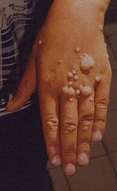 papiloma humano Imagen de la papiloma humano
